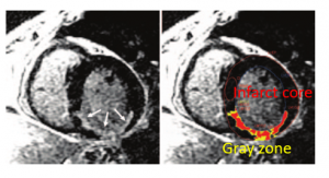 図4　（左）遅延造影像（LGE）、（右）Gray zone（黄色）とInfarct core（赤）の解析例　　 文献[6]　より改変引用